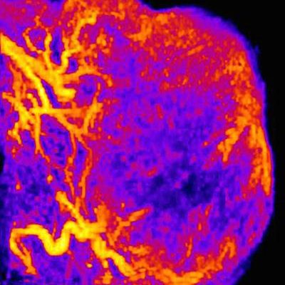 This is an intensity-colored image of blood flow in a PECAM1-positive tumor.