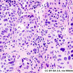 Histopathology slide of urothelial carcinoma
