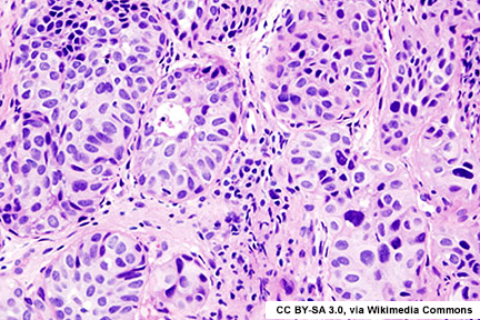 Histopathology slide of urothelial carcinoma