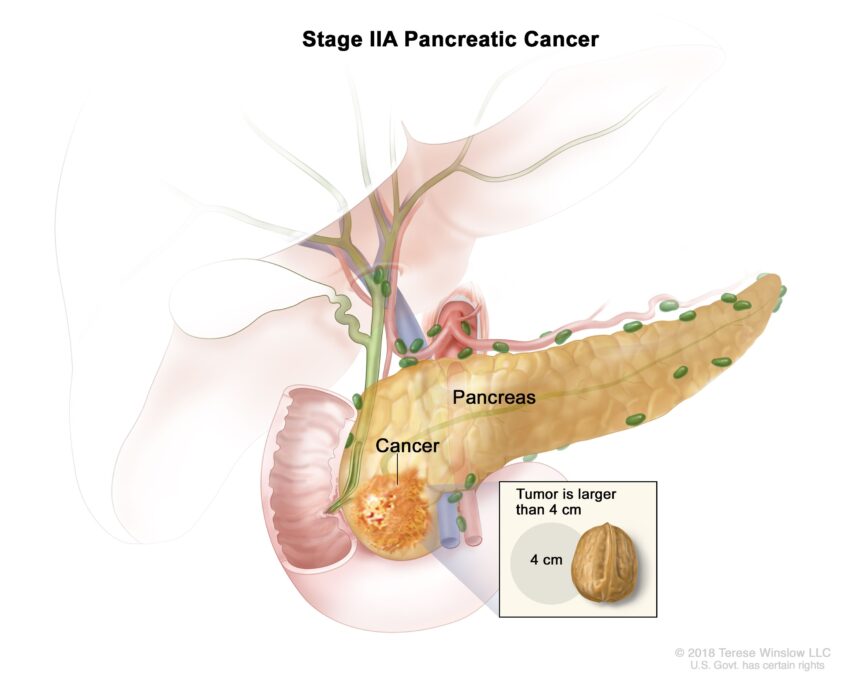 Diagram of pancreas with cancerous tumor