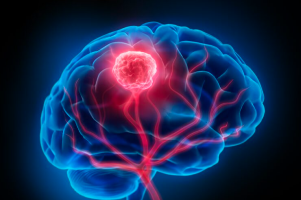 Illustration of the brain tumor called a glioblastoma.