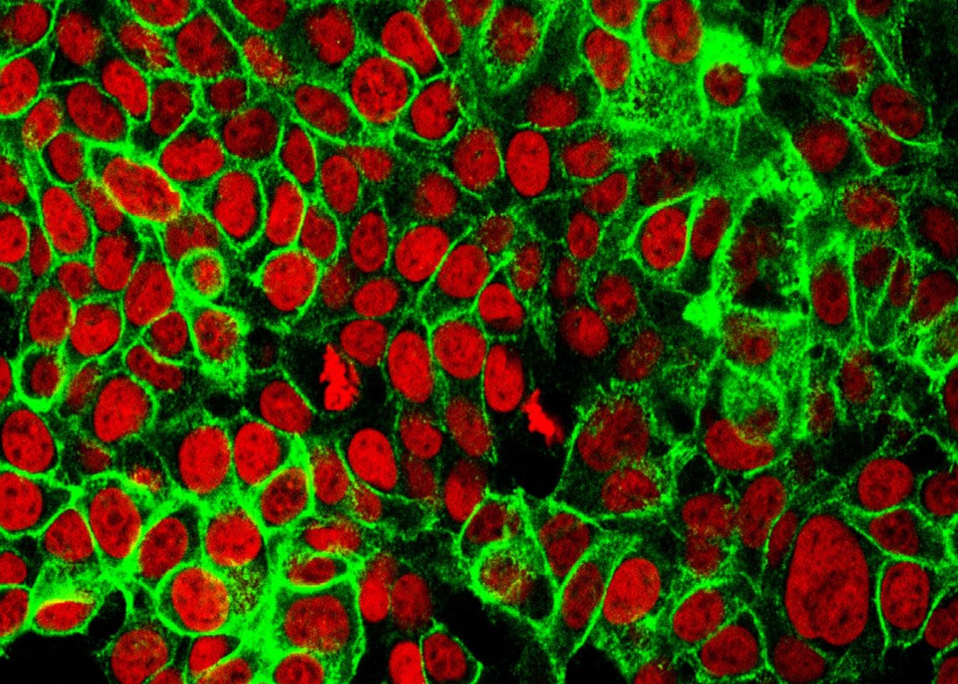 Human colon cancer cells with the cell nuclei stained red and the protein E-cadherin stained green. E-cadherin is a cell adhesion molecule and its loss signals a process known as the epithelial-mesenchymal transition in which cells acquire the ability to migrate and become invasive.